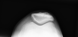 膝蓋大腿関節障害｜外側偏位