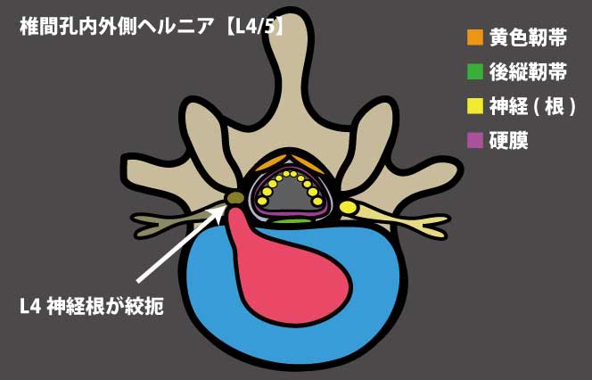 椎間孔内外側ヘルニア