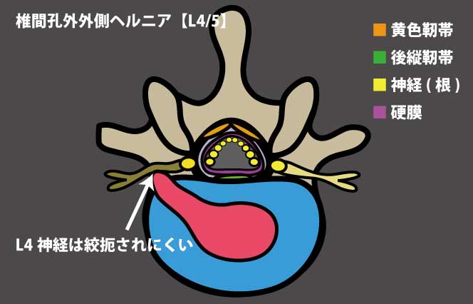 椎間孔外外側ヘルニア