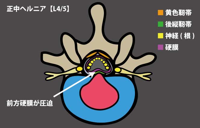 正中ヘルニア