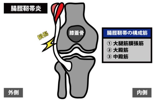 膝関節外側の痛みの原因とリハビリ治療 Rehatora Net