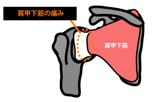肩関節前方の痛み：肩甲下筋の攣縮