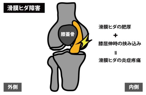 膝関節前面の痛みの原因とリハビリ治療 Rehatora Net