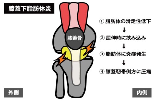 膝関節前面の痛みの原因とリハビリ治療 Rehatora Net