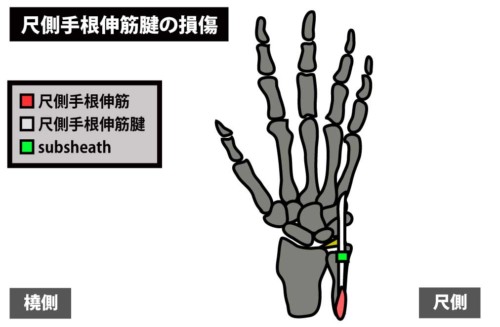 尺側手根伸筋腱の損傷