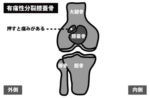 有痛性分裂膝蓋骨