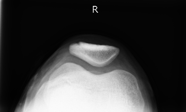 有痛性分裂膝蓋骨