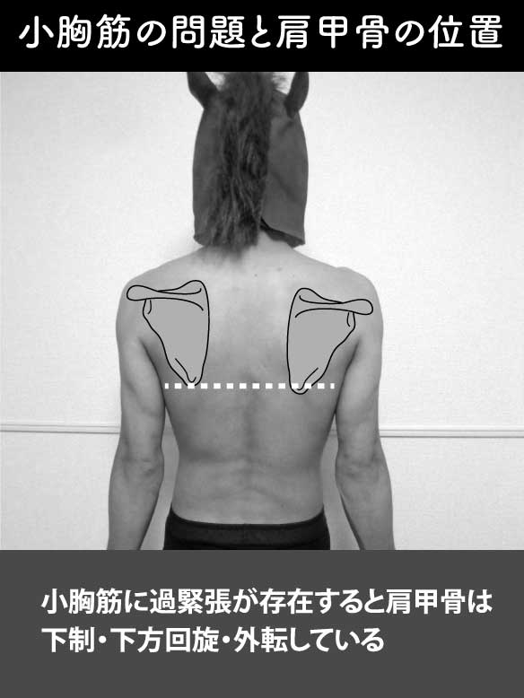 小胸筋が原因の肩関節痛について Rehatora Net