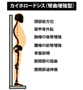 姿勢の分類：カイホロードシス