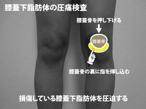 膝蓋下脂肪体の圧痛検査
