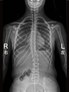 脊柱側弯症